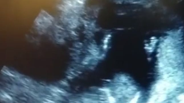 VIDEO Unborn baby appears to ‘clap’ during ultrasound Closer